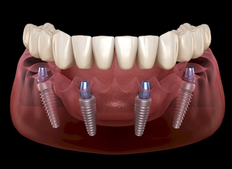 How Dental Implants Work: A Complete 2026 Guide