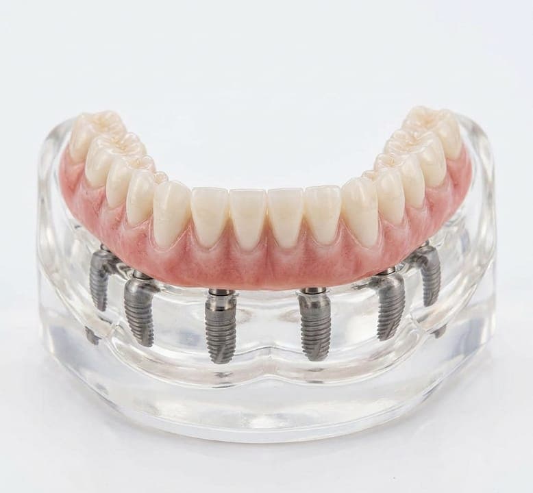 Implant Fixed Bridge Benefits: Your Complete Guide