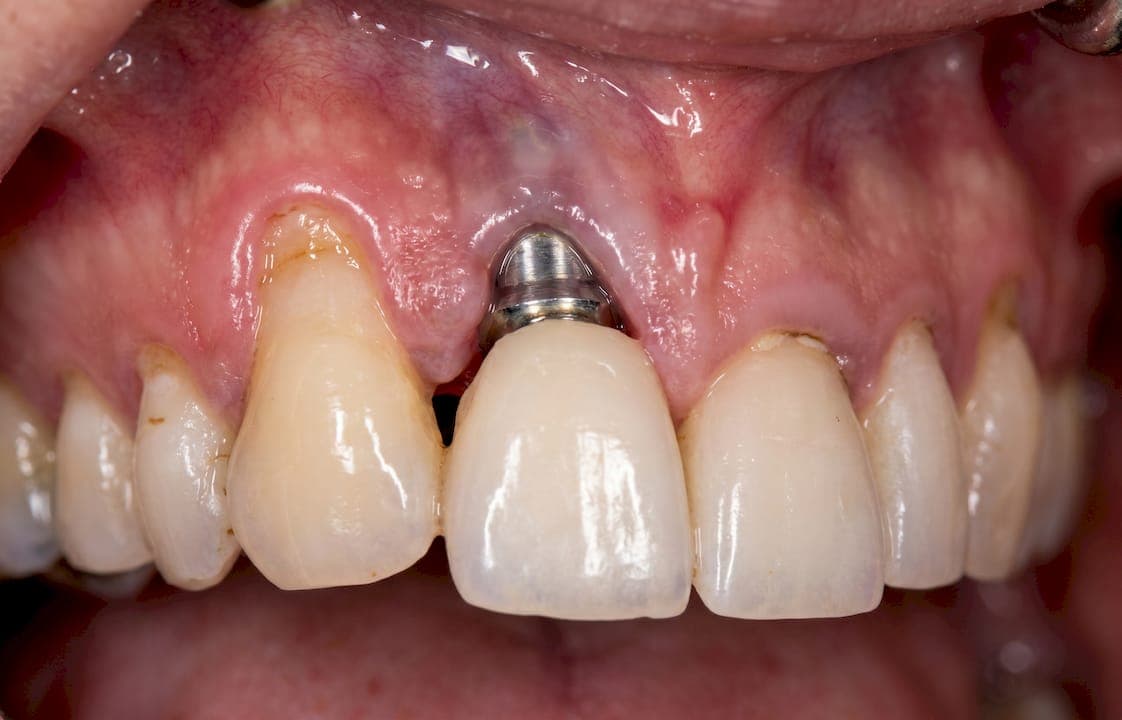 Why Dental Implants Fail: Causes and Prevention