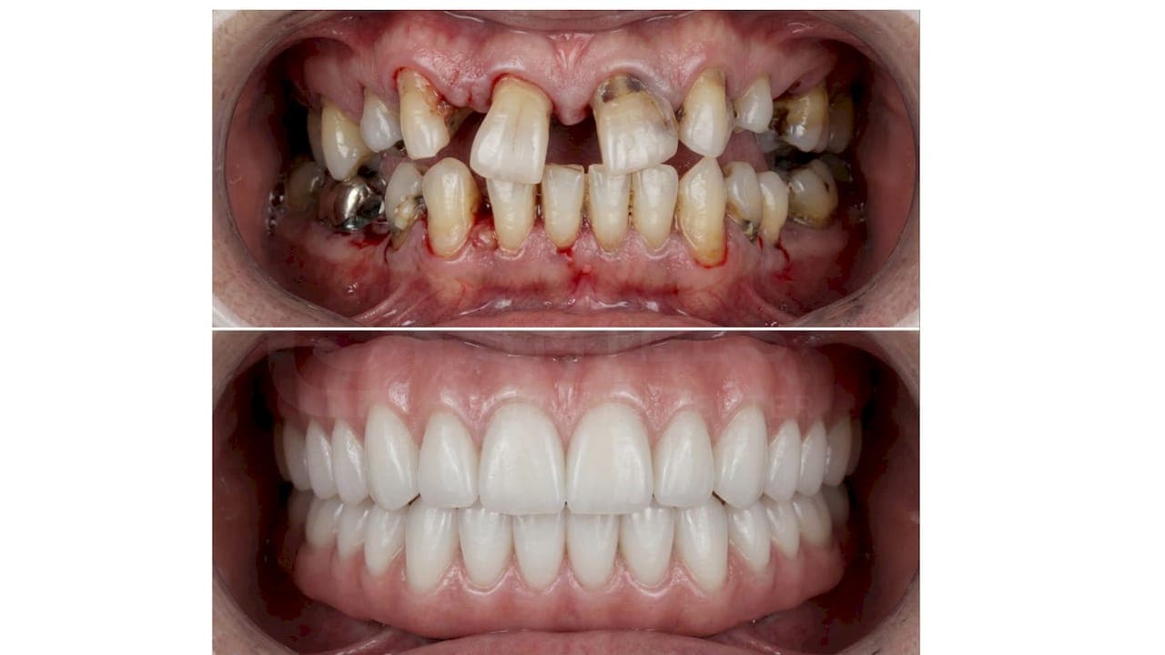 Dental Implant Candidacy Checklist for Complex Cases