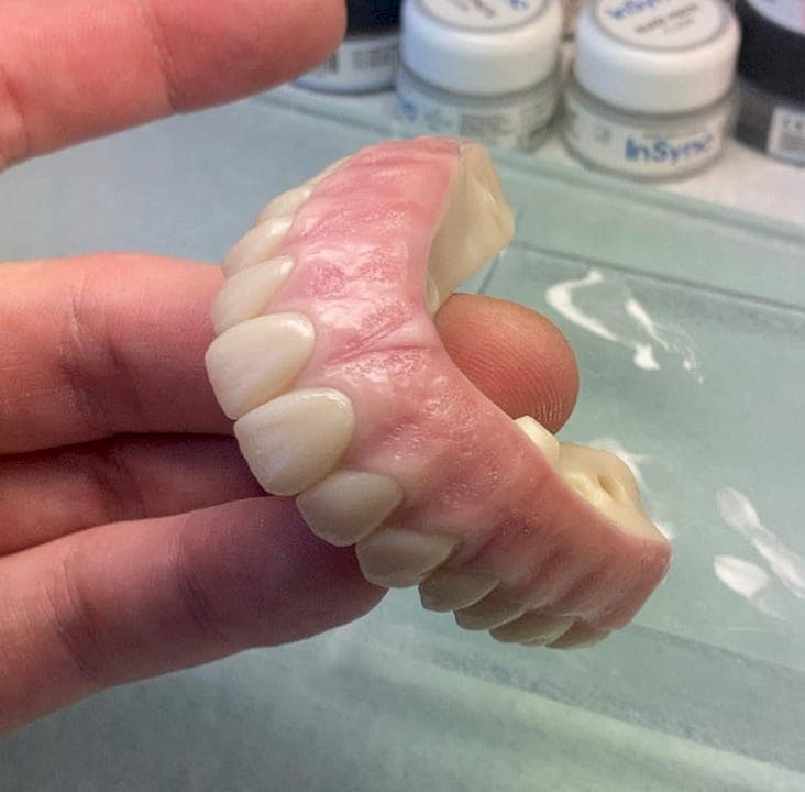 Palate-Free Implant Prosthesis: Comfort, Taste, and Stability