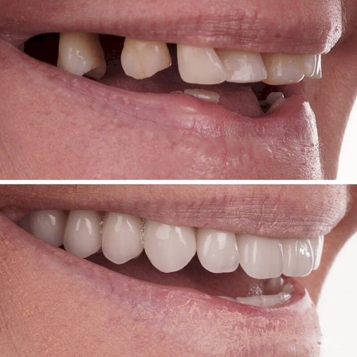 What Is a Screw Retained Implant Arch? A Patient's Guide
